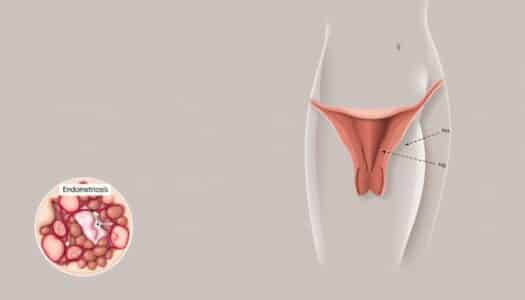 was ist endometriose